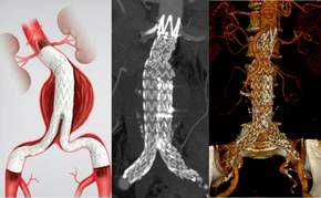 Endovaskulär behandeltes Bauchaortenaneurysma