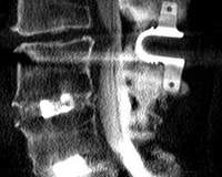 Röntgenaufnahme einer unteren Lendenwirbelsäule mit einoperiertem Metallteil zwischen zwei Wirbeln.