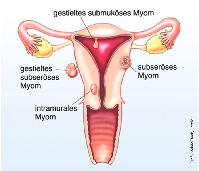 Lange entfernung wie krank gebärmutter myom Wie lange