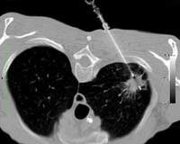 Ein Querschnitt einer Computertomographie-Aufnahme einer Lunge während einer Lungenpunktion mit einer Nadel.