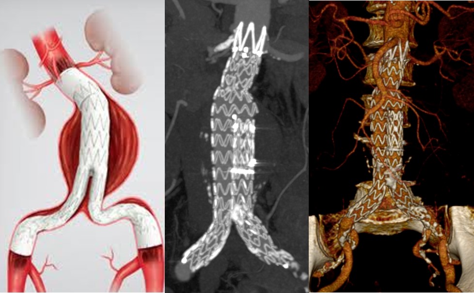 Endovaskuläre Aortenbehandlung